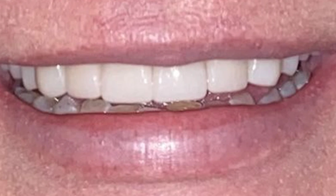 Cosmetic Smile Makeover — after